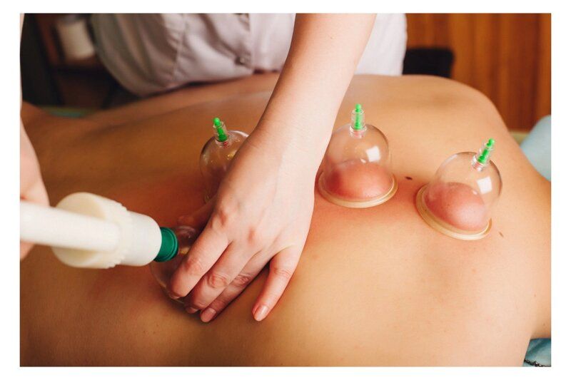 Hijama Therapy for Migraine and Headache Relief