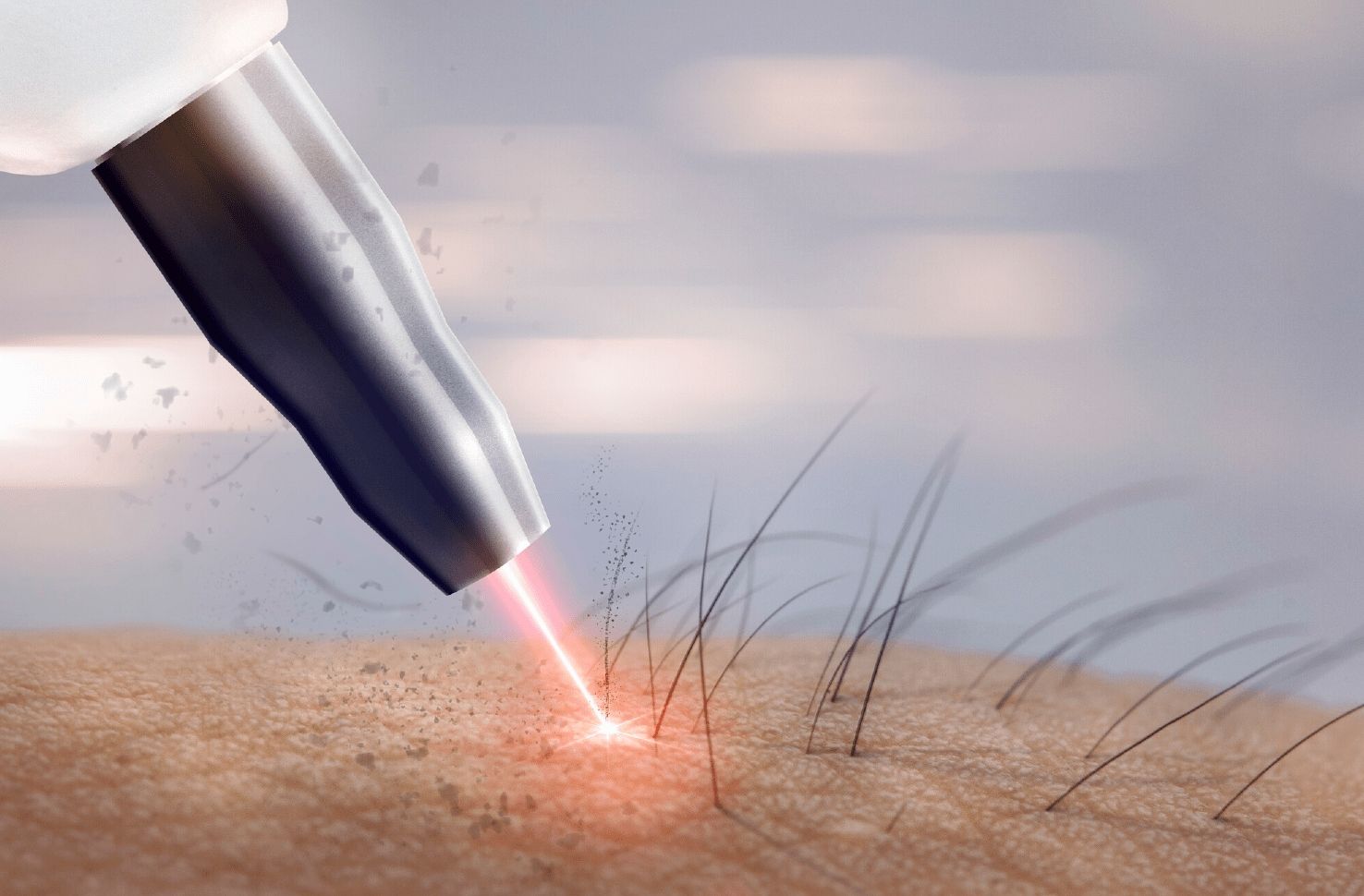 How Laser Hair Removal Targets Root of Hair?